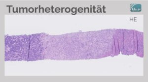 mRNA-Corona-Impfung – Auslöser von Krebs/Turbokrebs!? Interview mit Frau Dr. med. Ute Krüger